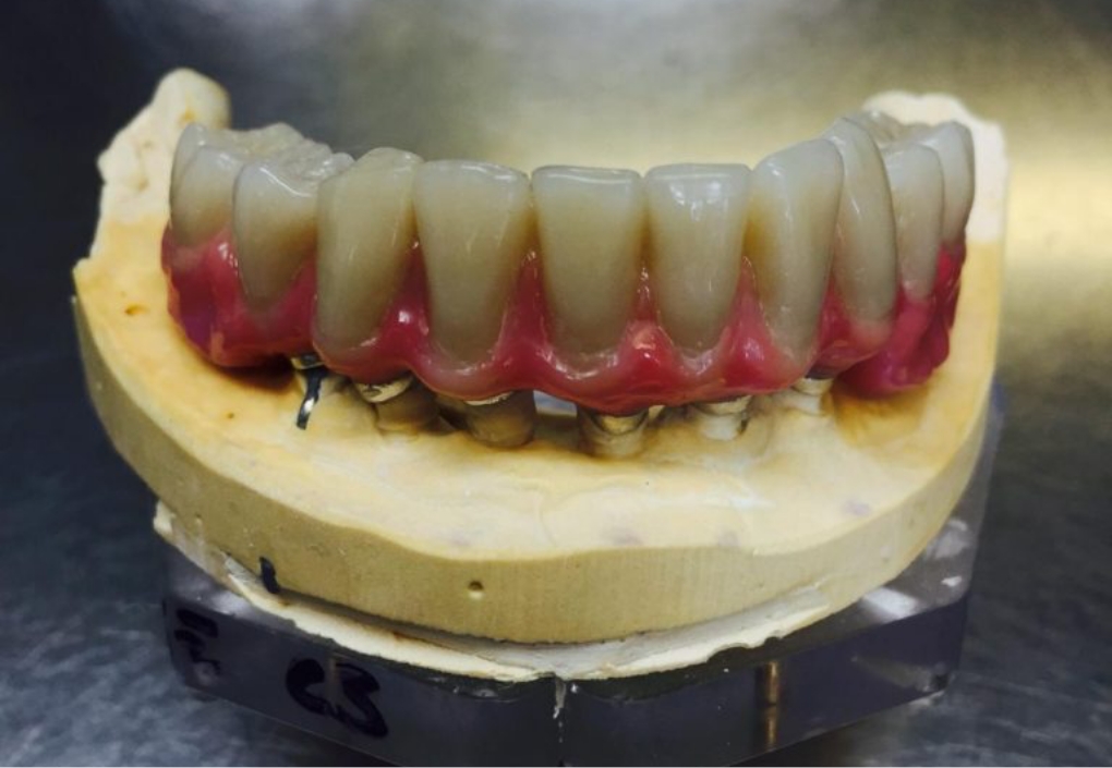 Implant Retained Dentures