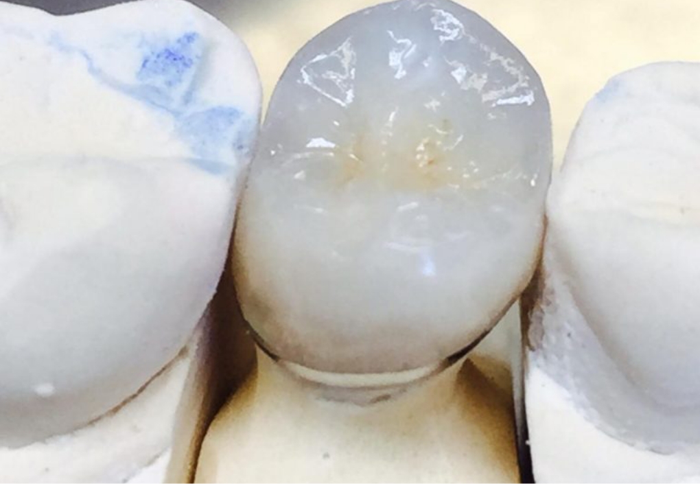 Porcelain Bonded Crowns