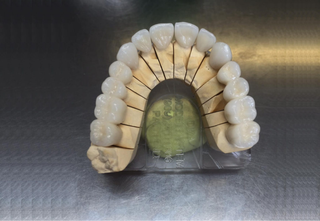 Zirconia based porcelain layered crown/Veneer